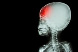 Indianapolis Brain Injury and Children