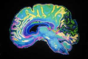 Long Term Effects of Indianapolis Brain Injury