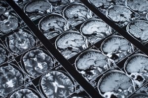 Indianapolis Head Injury Attorney