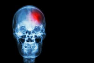Indianapolis Brain Injury Attorney
